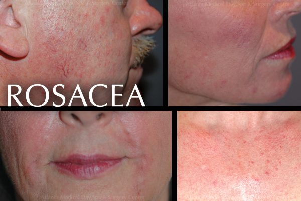 Rosacea Relief. What are the best treatments for me? |